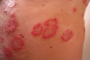 psoriasis symptoms are episodic